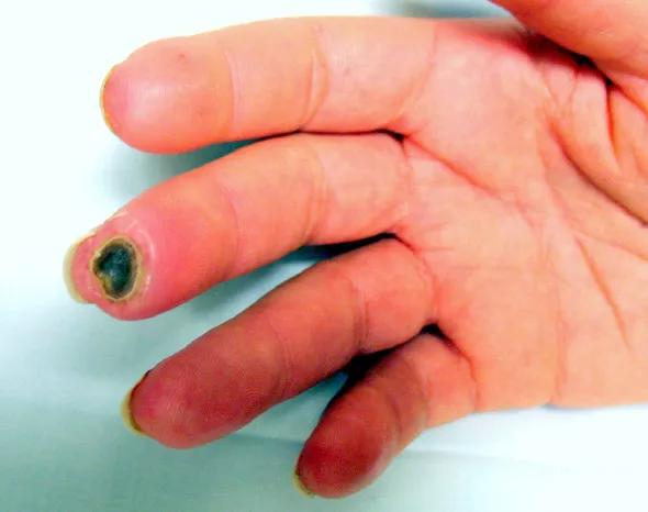 Figure 1. Ischemic digital ulcer in a patient with scleroderma. 