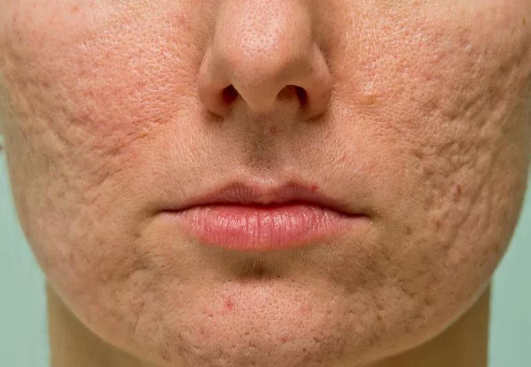 The Best Ways To Get Rid of Acne Scars