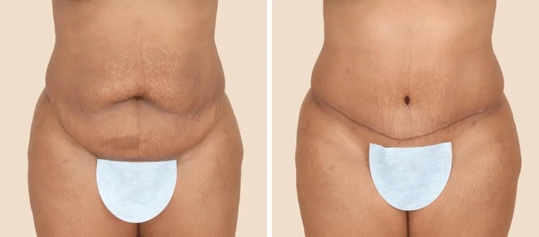 Before abdominoplasty (left) and nearly 3 months after (right).