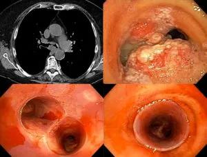 Bronchoscopy