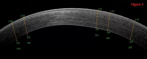 Enhancement 13 Years After Lasik