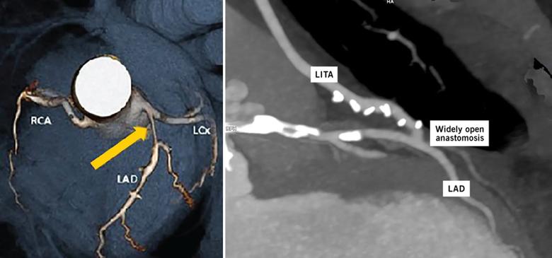 two clinical applications of coronary CT angiography