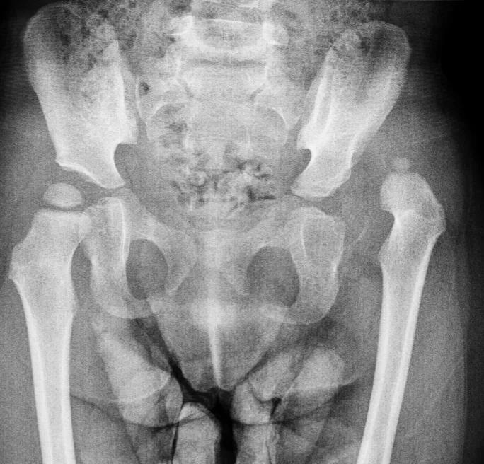X-ray of pelvis