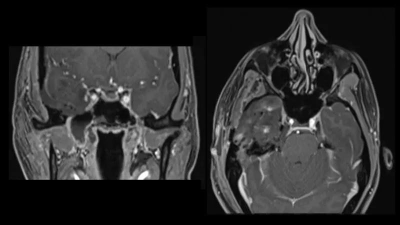 two brain scans presenting different directional views of a patient's head
