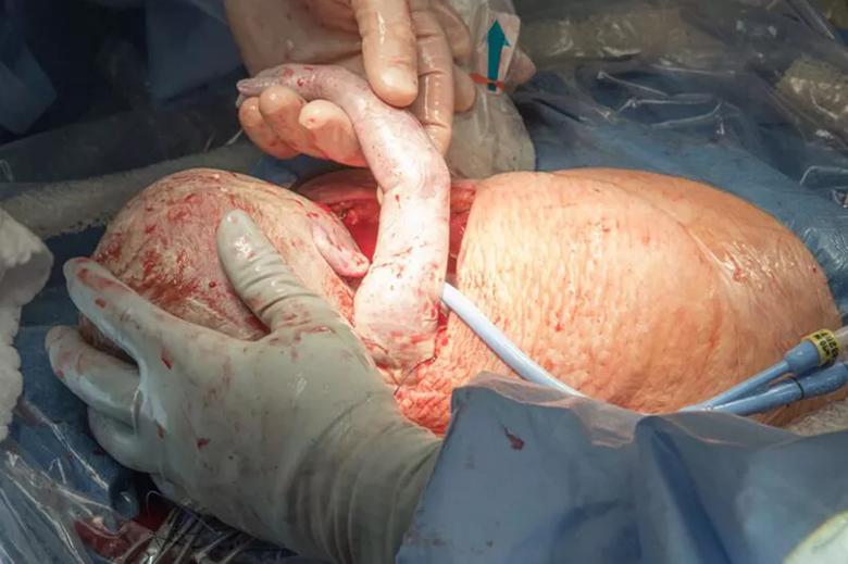 Photo of fetal surgery.