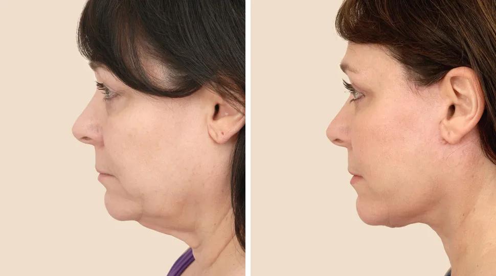 Facelift before & after photo