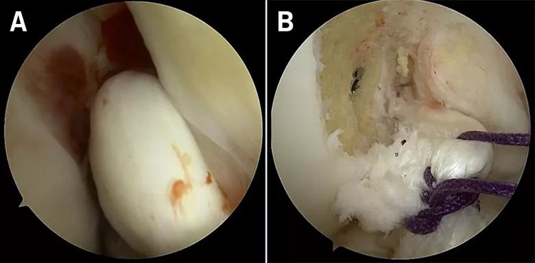 Repairable stump and a sutured stump prior to implantation of BEAR implant