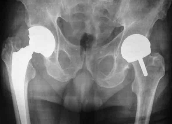 Figure. Right total hip replacement with left BHR. Note the bone loss of the upper femur.