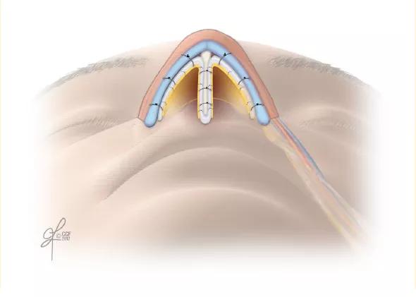 14-ENT-2015-Fritz-Inset-Image-Fig-3-590pxl-width