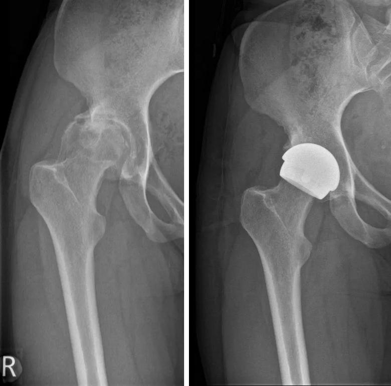 Imaging scans before and after hip resurfacing with the H1 implant