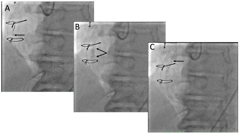 three sequential intraprocedural scans from a cardiac procedure