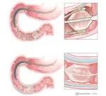 Mucosal ablation