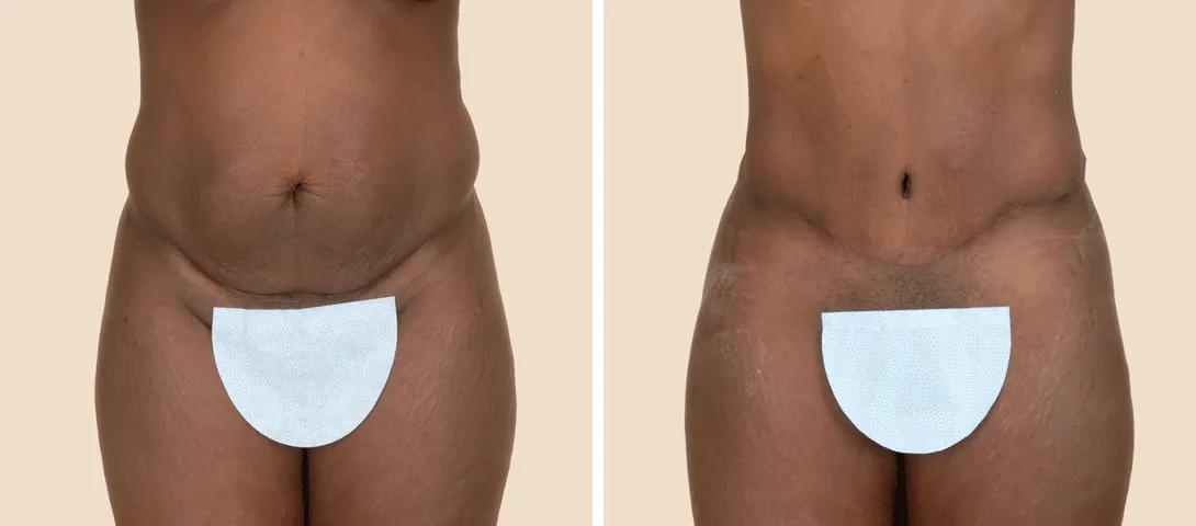 Before abdominoplasty (left) and 6 months after surgery (right).