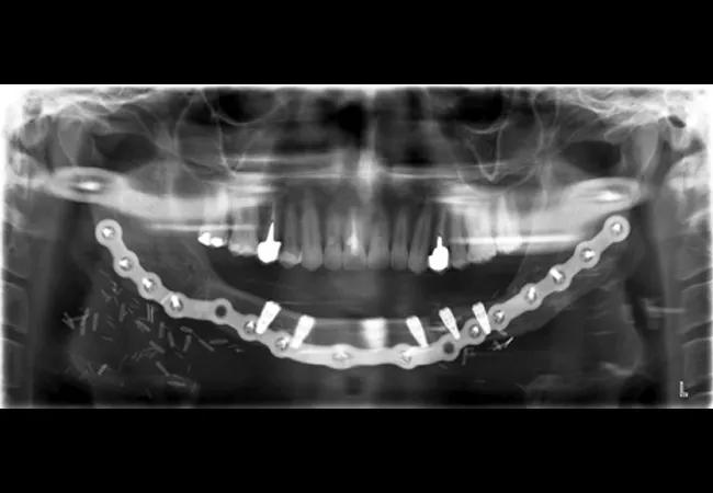 by oral and maxillofacial surgery and microvascular reconstruction by the Head & Neck Surgery team 