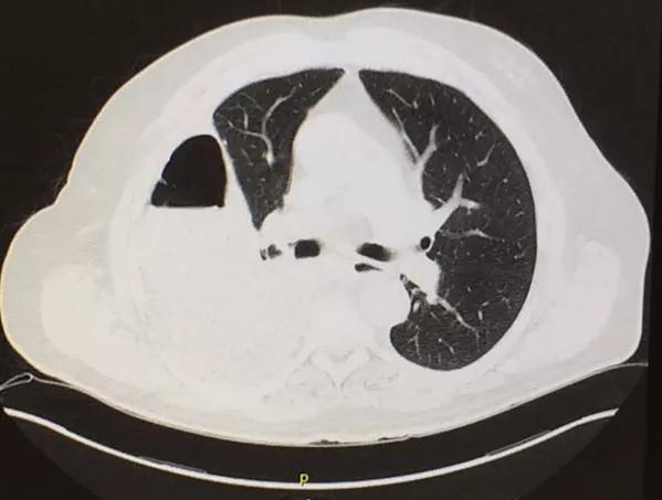 Pleuritic Chest Pain And Shortness Of Breath In A 76-year-old Man With 