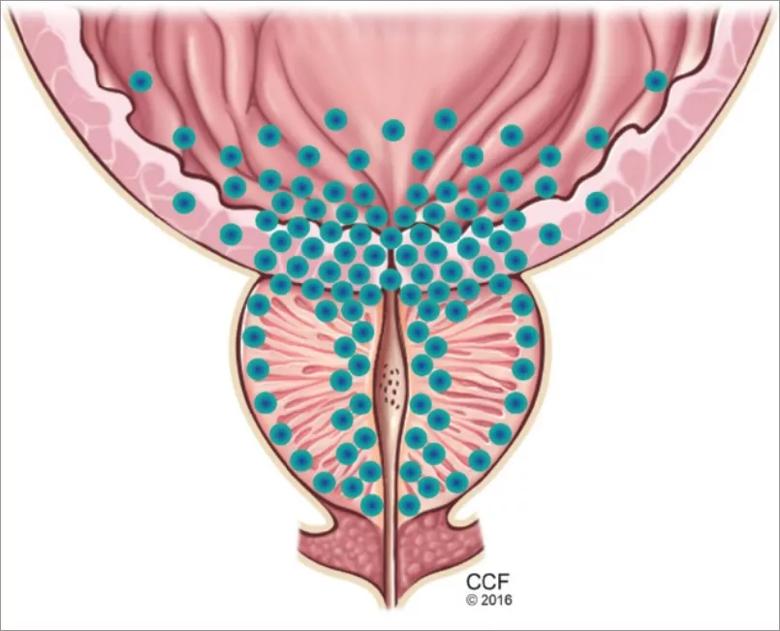 Benign prostatic hyperplasia (BPH)