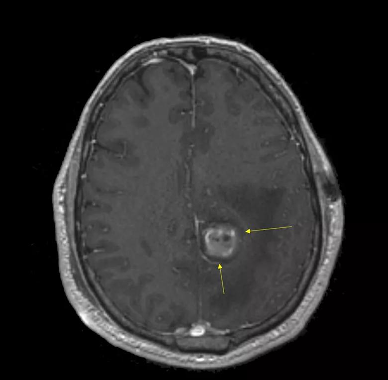 CT scans of the brain.