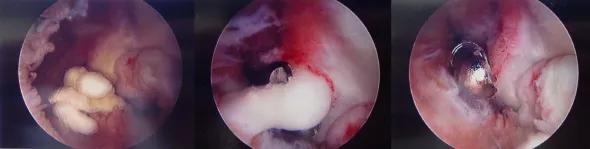 Figure 3. Arthroscopic view of an elbow with abundant soft tissue adhesions (left). Arthroscopic lysis of adhesions (middle) and debridement (right). 