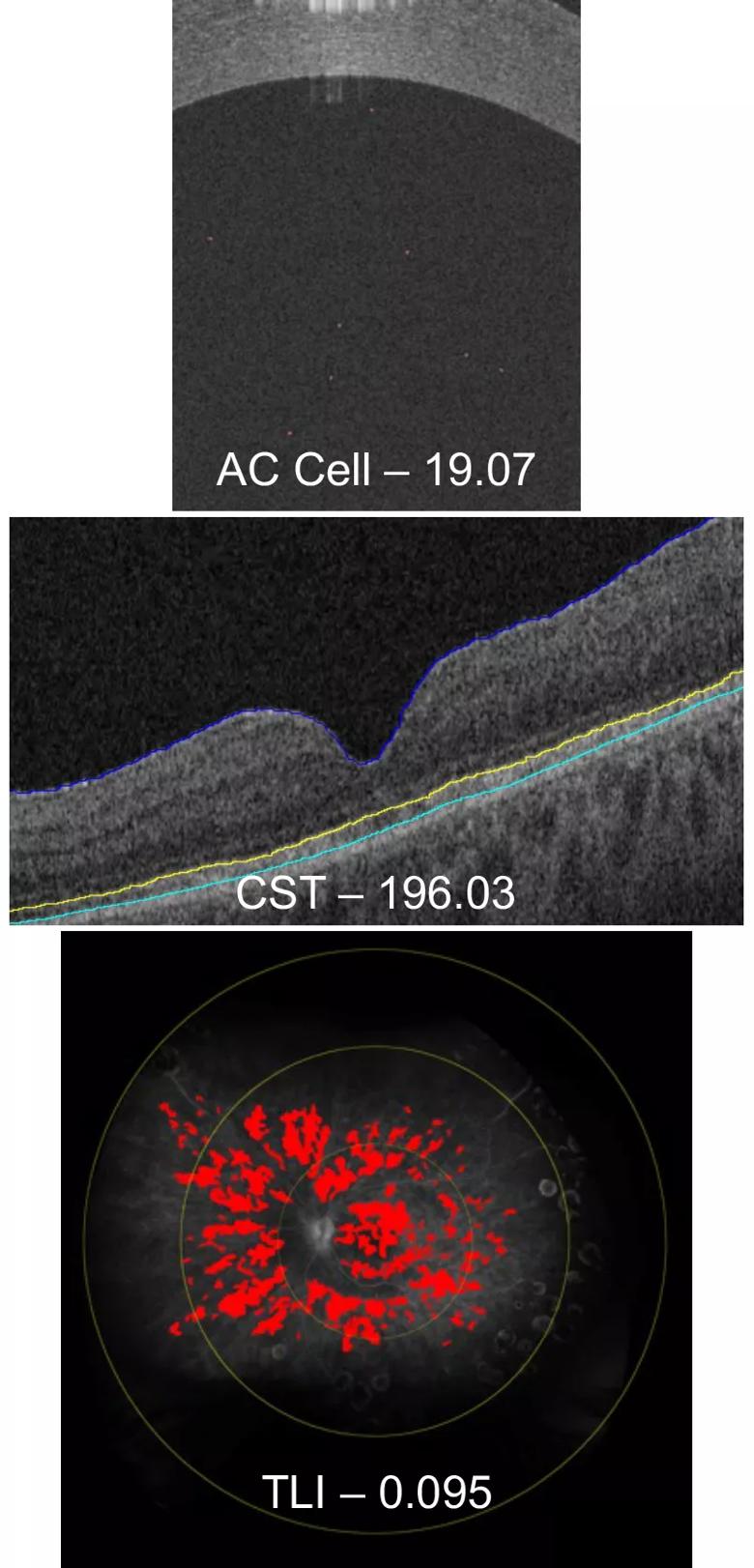 Imaging of patient with intraocular inflammation