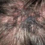 Scalp Melanoma