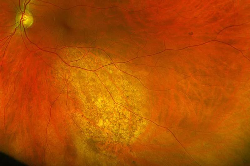 Regression of macular tumor after cancer treatment
