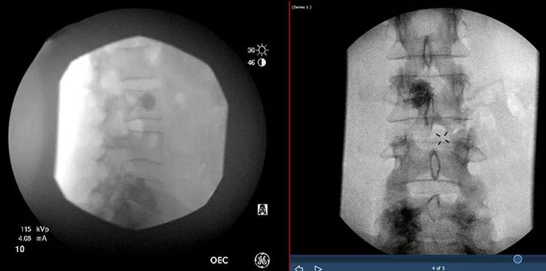 radiofrequency ablation and cementoplasty of spinal metastases