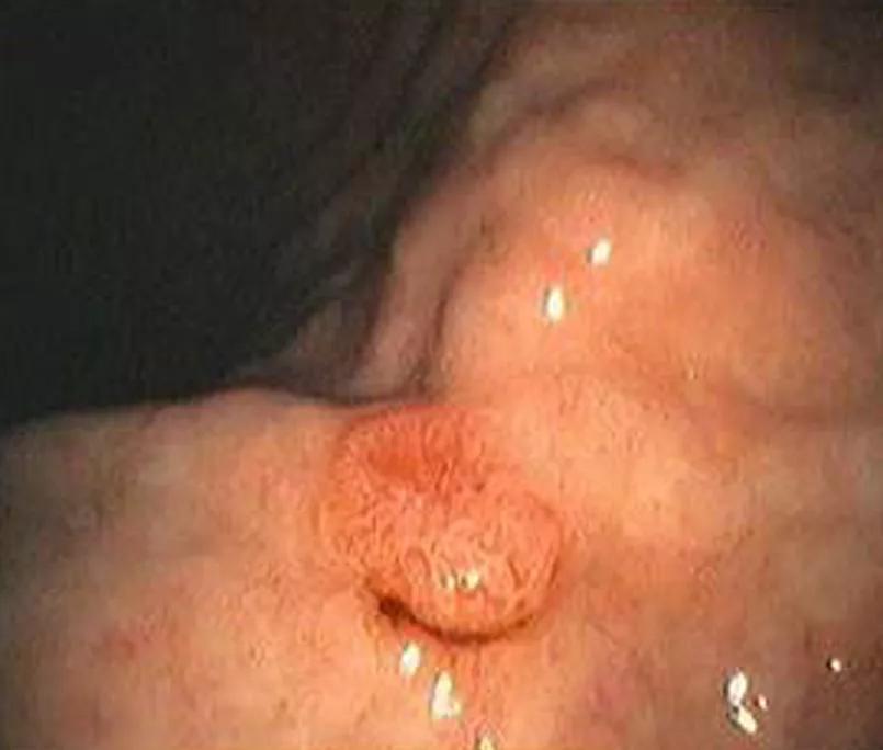 Gastric neuroendocrine tumor