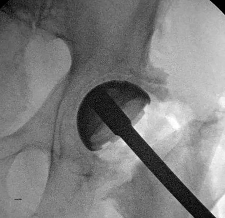 Position of the acetabular component