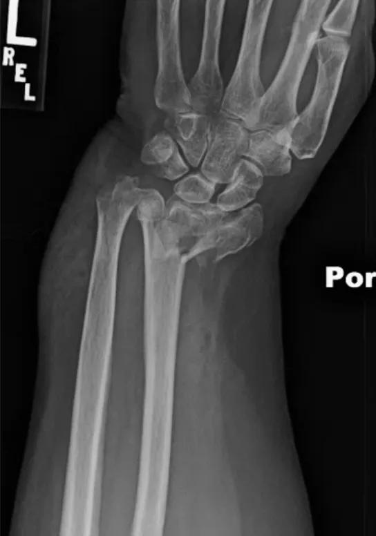 X-ray of broken wrist