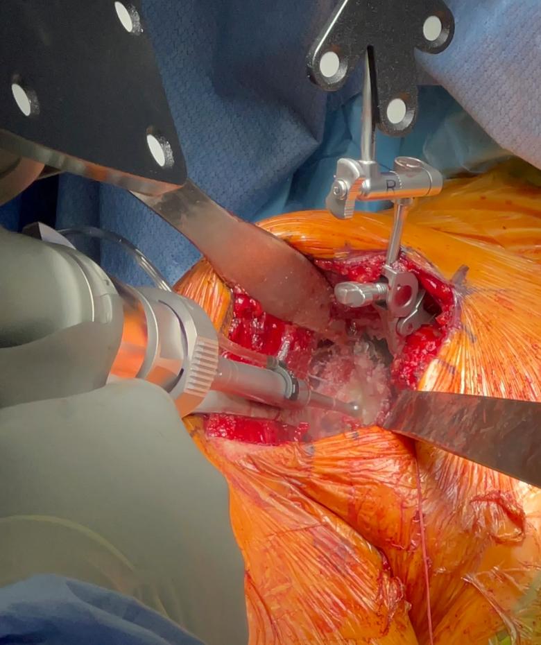 Drill removing a portion of the shoulder joint during surgery