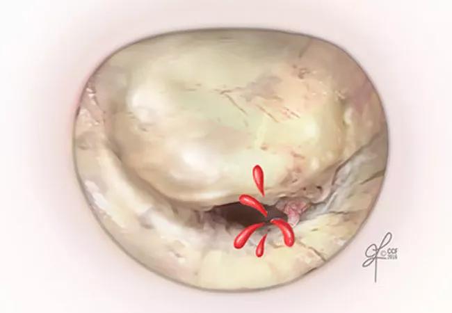 Mitral valve prolapse