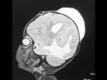 Massive in utero hydrocephaly that first required VP shunt and subduroperitoneal shunt because of sudural hygroma.