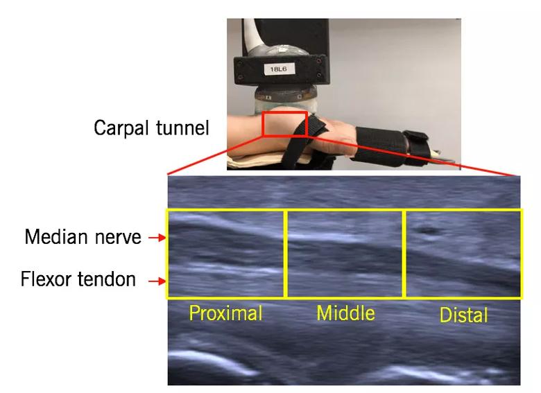 Carpal tunnel showing median nerve and flexor tendon