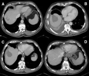 CT images after laparoscopic ablation