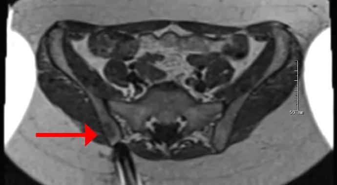 Figure 1. T2-weighted MRIs during and after the biopsy. On the left is an axial image showing the needle approaching the bone lesion (arrow). The middle image shows the needle tip within the lesion. The right image, which is from a post-biopsy coronal STIR sequence, shows the needle tracks (two bright round areas denoted by arrows) from the patient’s two biopsies, which are surrounded by abnormal signal consistent with a lesion. 