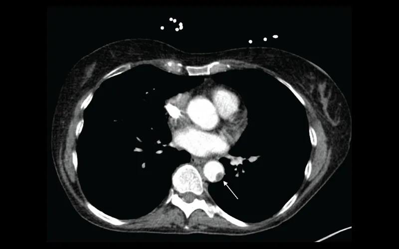 CT scan