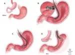 Endoscopic sleeve gastroplasty