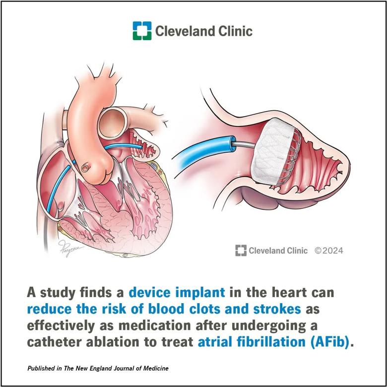 Artist rendering of left atrial appendage closure procedure.