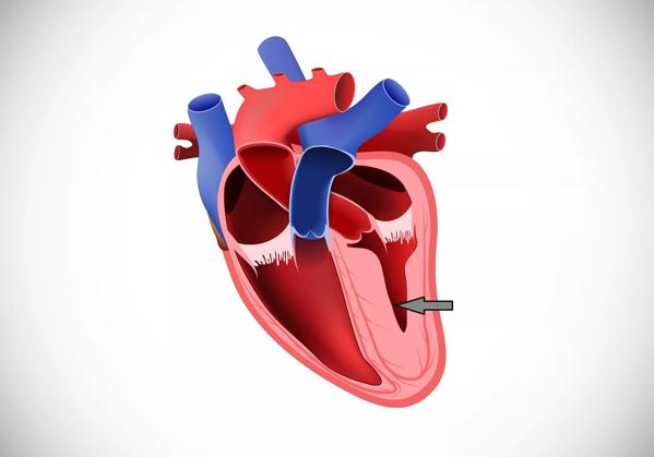 Cardiomyopathy. cross section of human&#8217;s heart