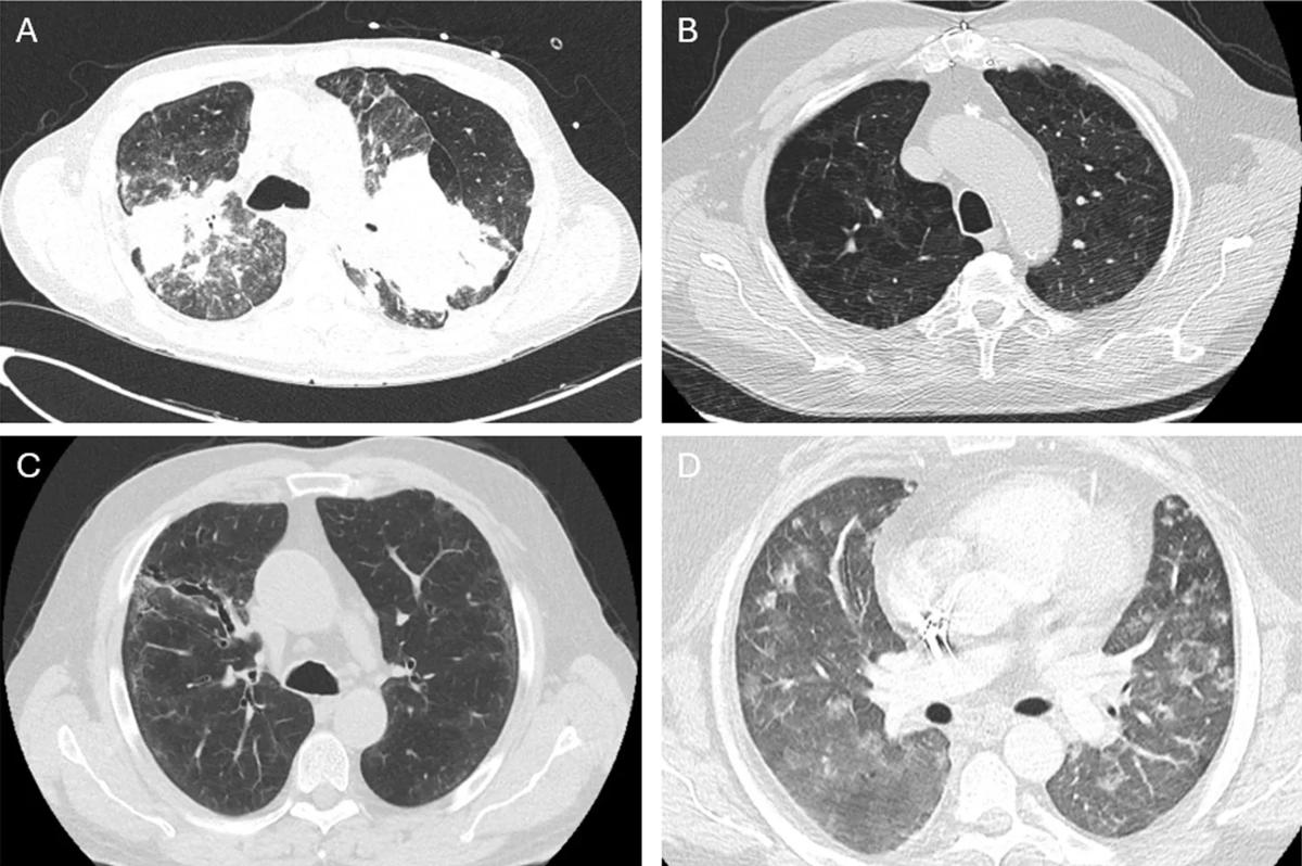 Scans of lung disease caused by coal mine dust
