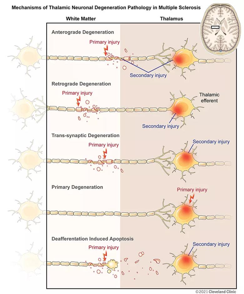 mechanisms of thalamic neuronal degeneration pathology in multiple sclerosis