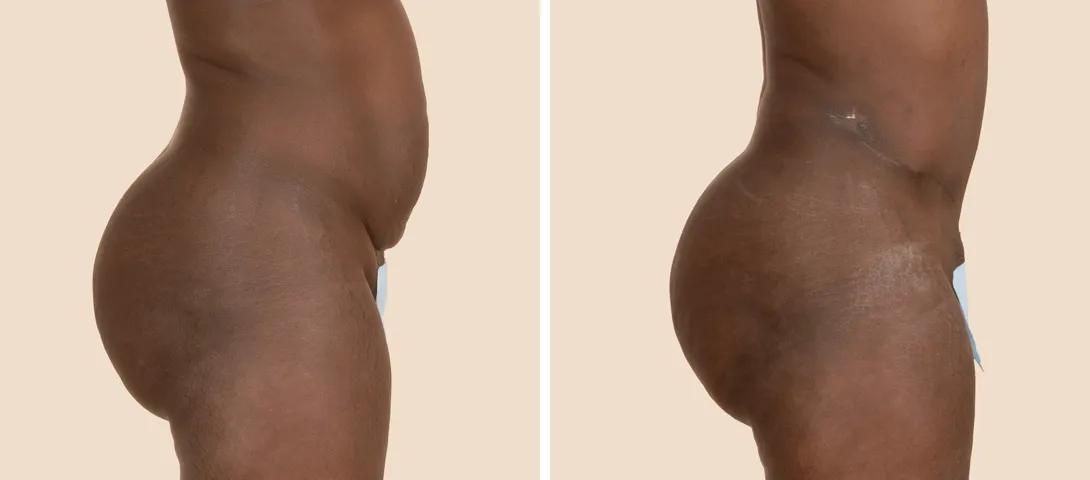 Before abdominoplasty (left) and 6 months after surgery (right).