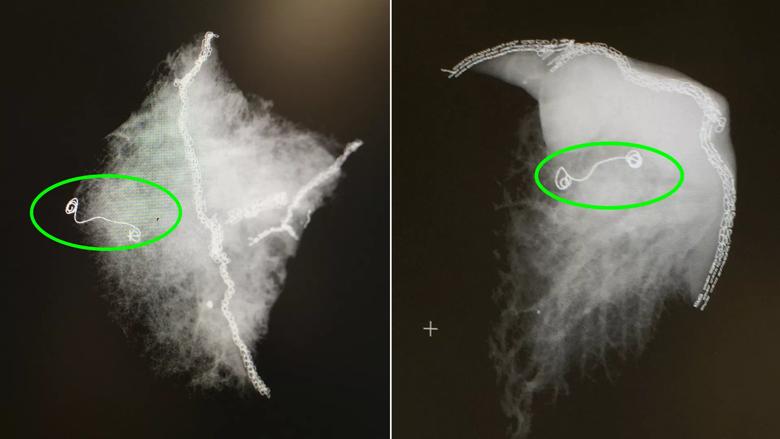 lung microcoil Cleveland Clinic