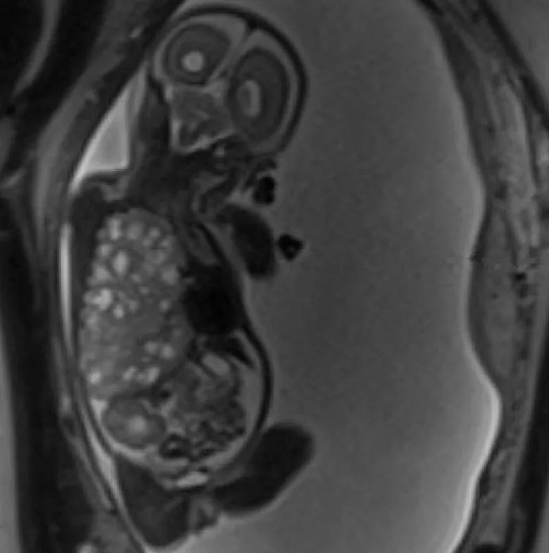 A presurgical MRI image shows the large right-sided congenital lung malformation occupying most of the thoracic cavity.