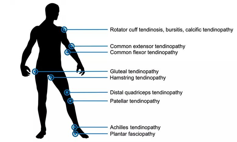 Human body with highlighted areas of tendinopathy