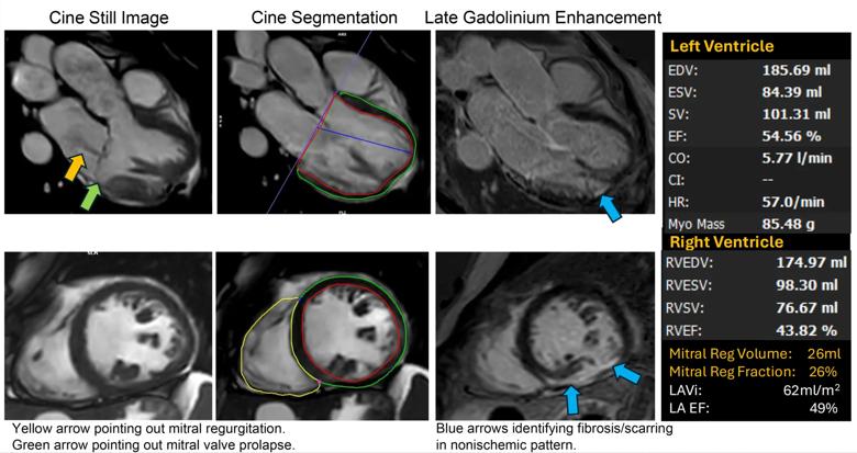 multi-panel figure with 6 heart image scans and a data chart