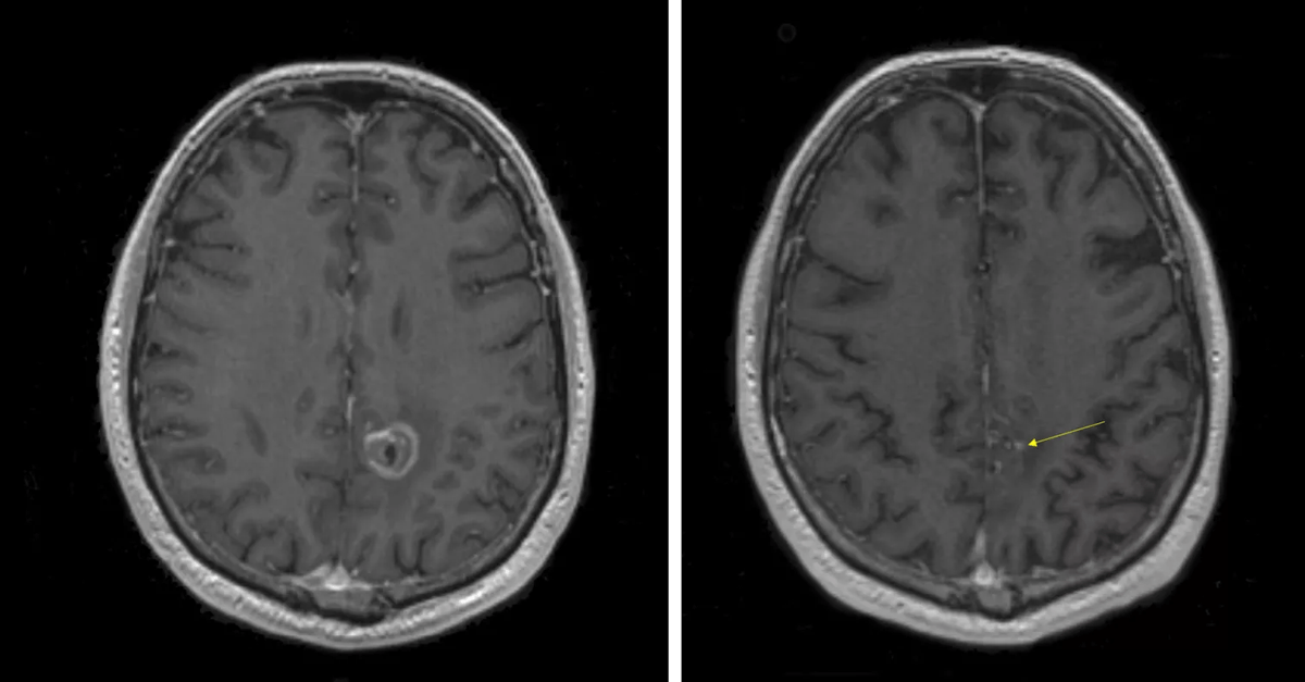 CT scans of the brain.