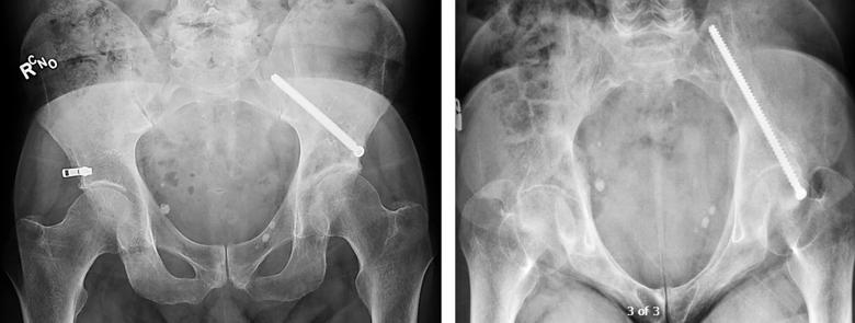 X-ray images of pelvic ring fixation