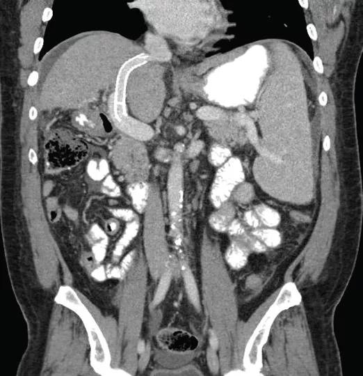 Liver-Transplant-fig1
