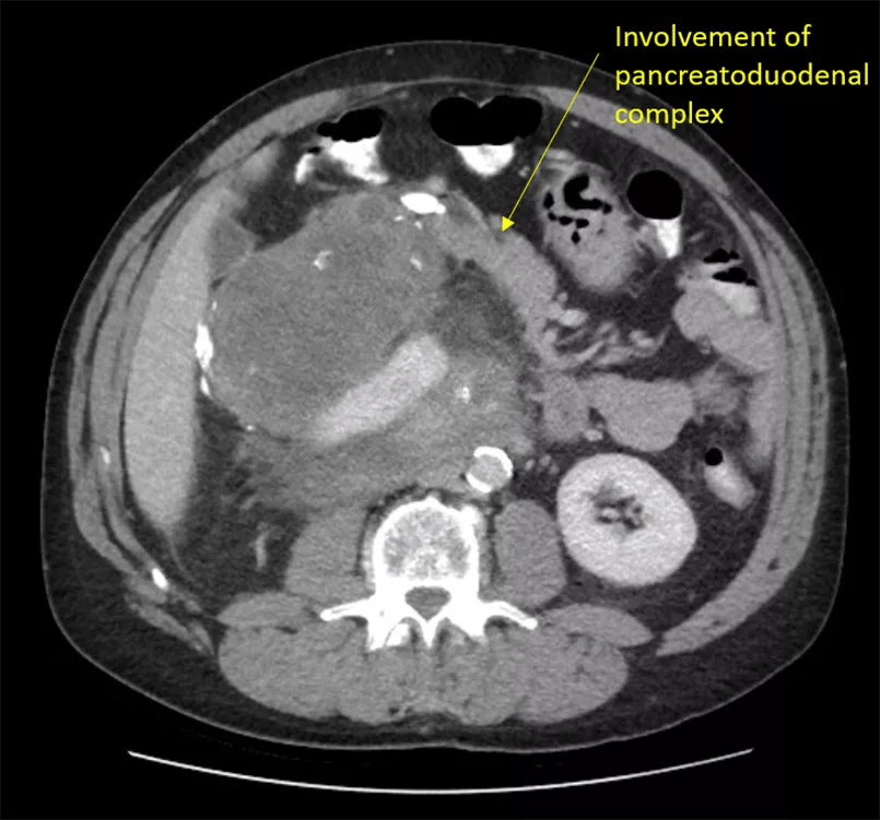 CT scan